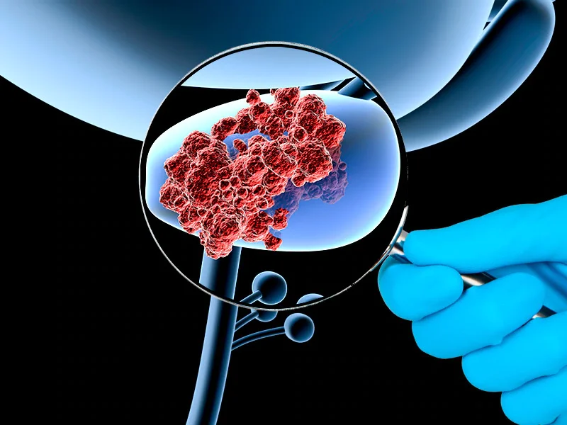 Oncología Masculina - Tratamiento Especializado